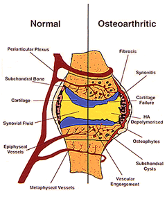 arthrose